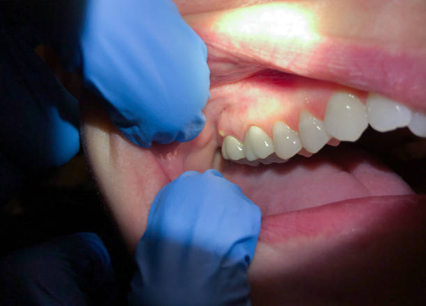 Best Emergency Dental Care for Broken or Chipped Teeth in Sterling, IL