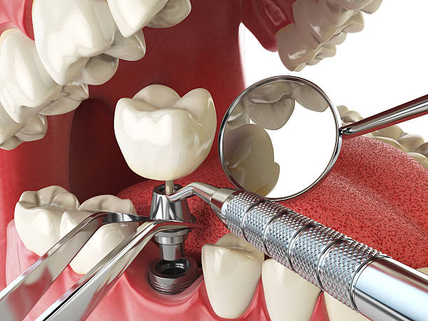 Best Emergency Treatment for Dental Infections or Abscesses in Sterling, IL